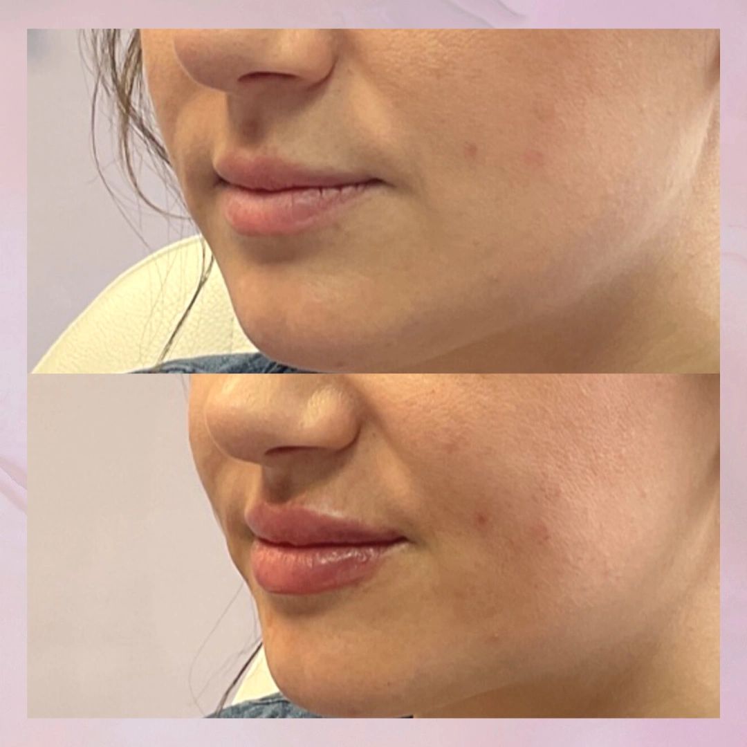 lip filler before and after