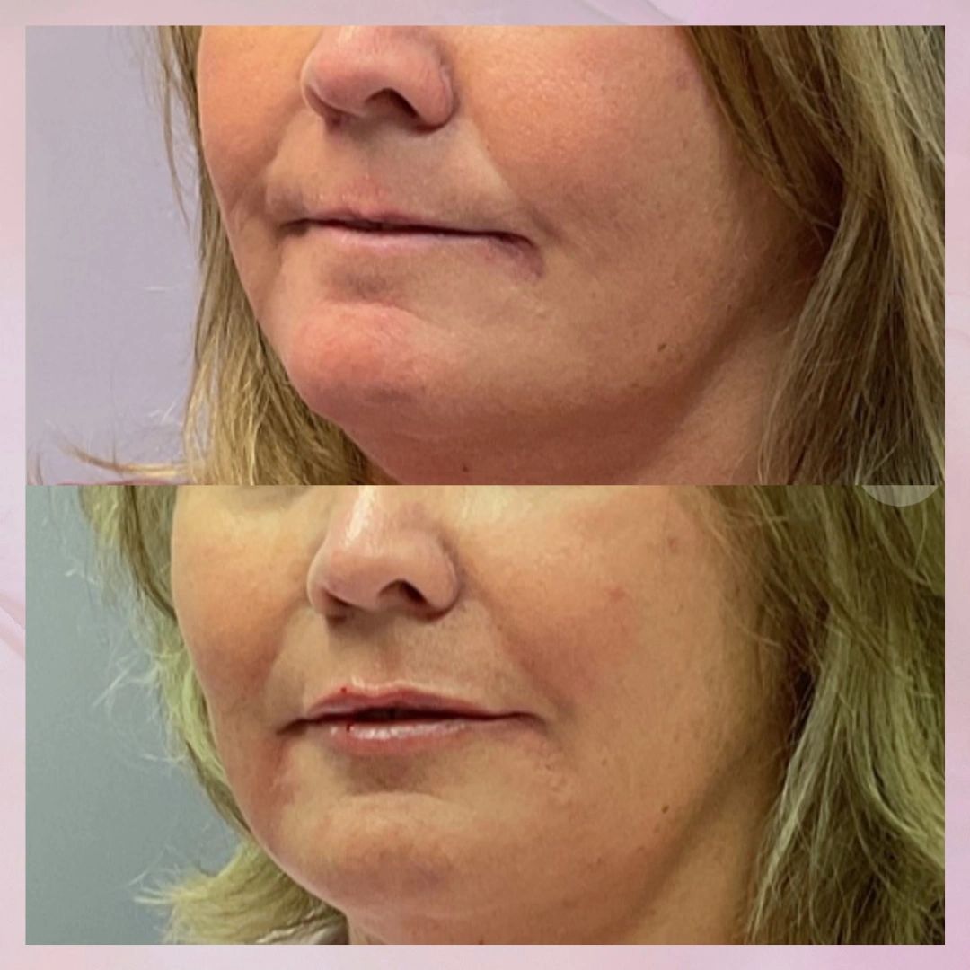 lip filler before and after