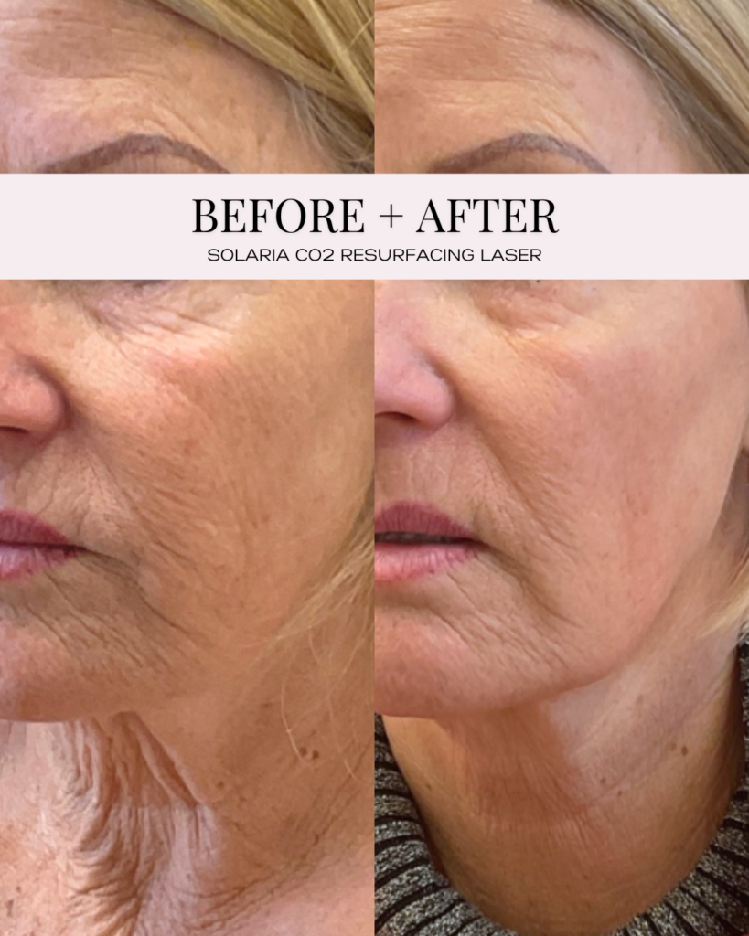 solaria co2 laser transformation