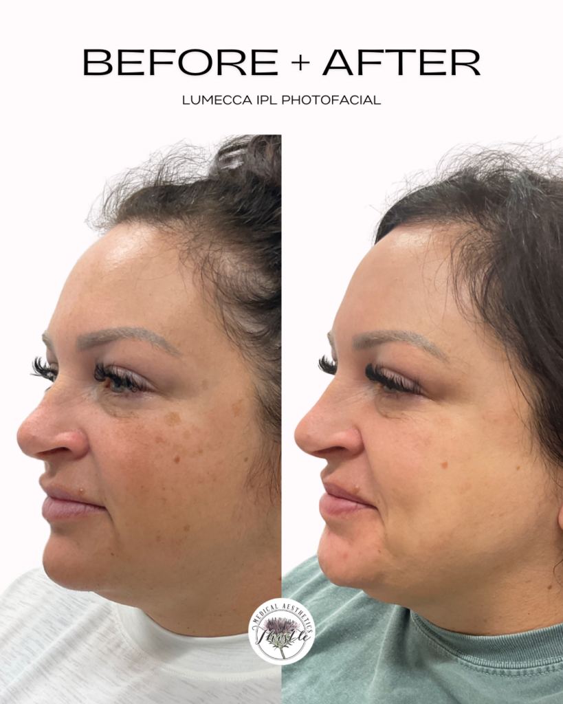 lumecca ipl photo facial