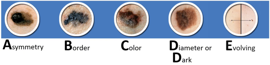 ABCDEs of melanoma
