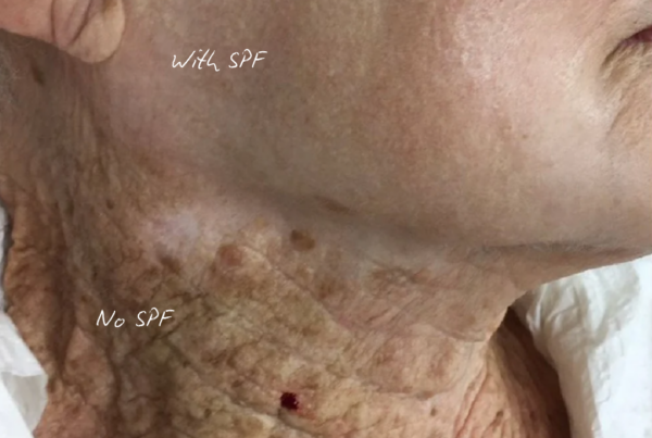 photo of skin with spf use and without spf use