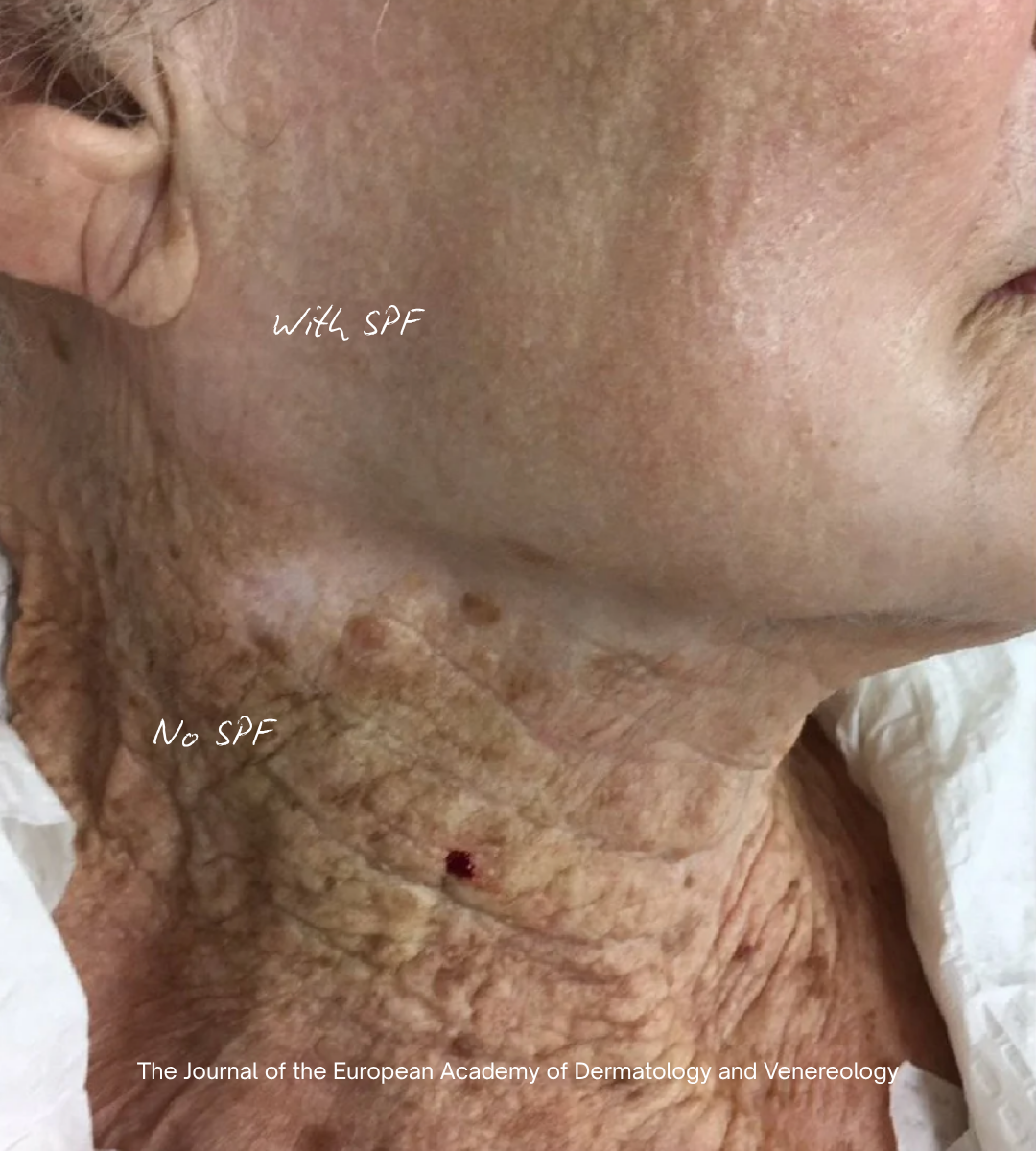 photo of skin with spf use and without spf use